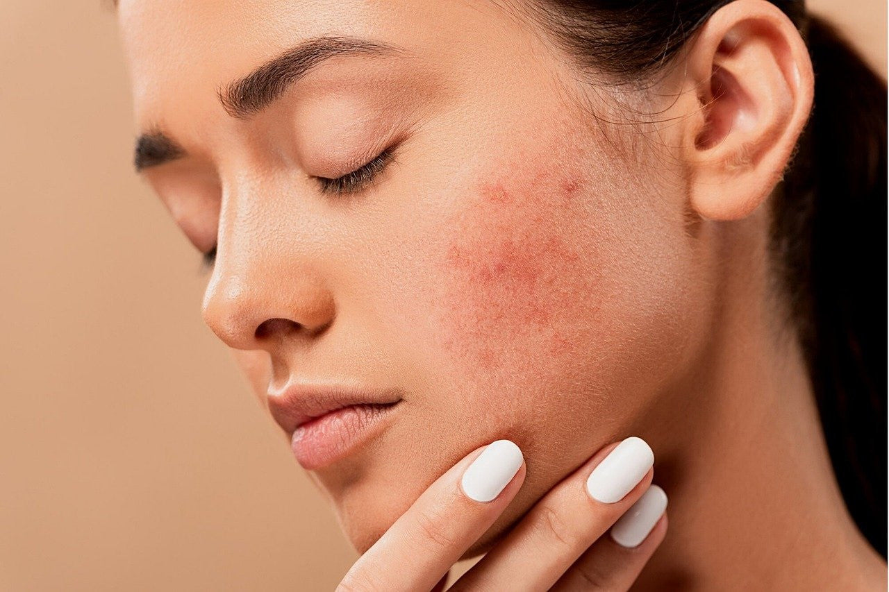 Brufoli e acne in gravidanza e allattamento: cause e rimedi.