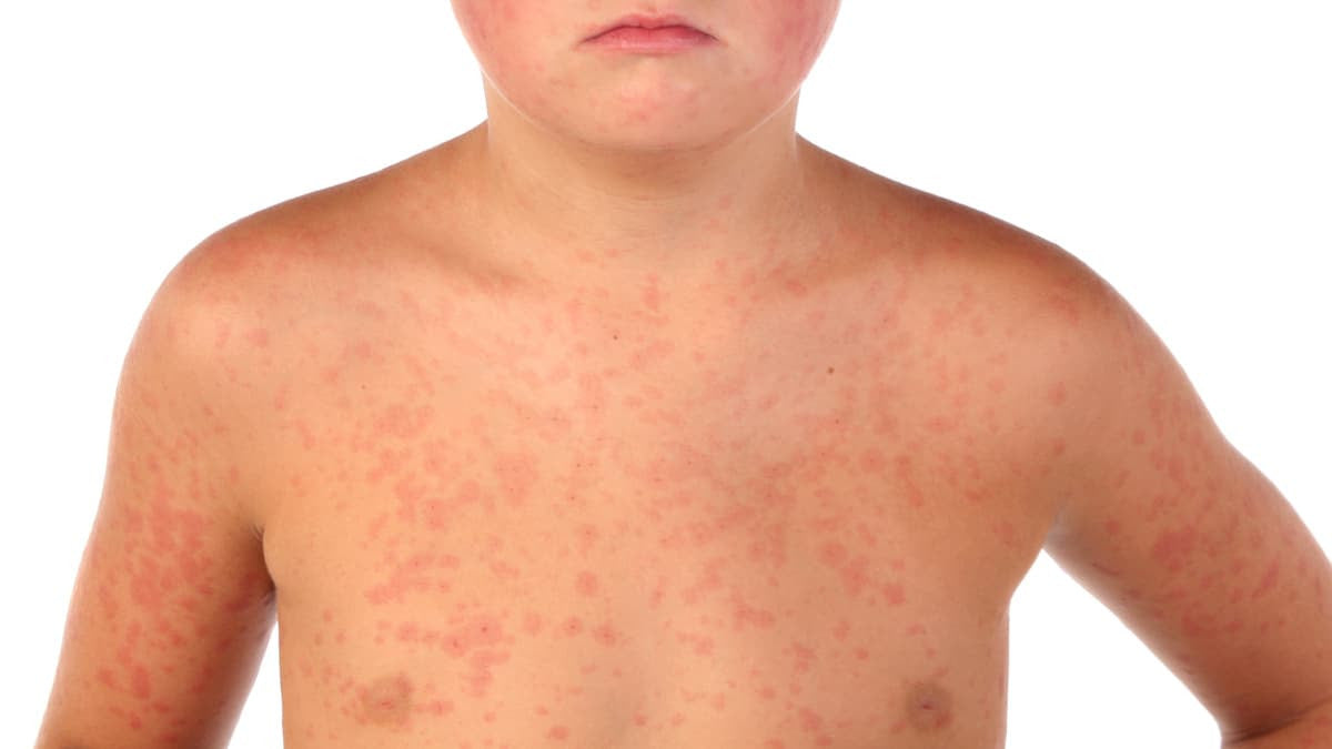 La quarta malattia nei bambini